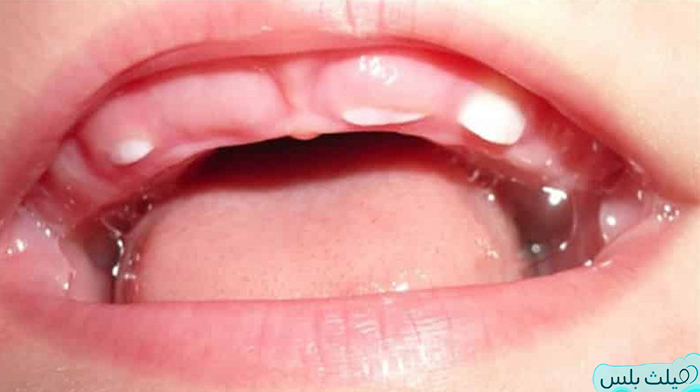 ظهور-الناب عند الرضع قبل الأسنان