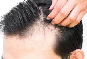 علاج تساقط الشعر بالأعشاب