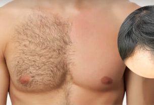 أسباب تساقط شعر الجسم عند الرجال
